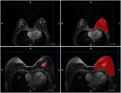 Diagnosis of benign and malignant nodules with a radiomics model integrating features from nodules and mammary regions on DCE-MRI